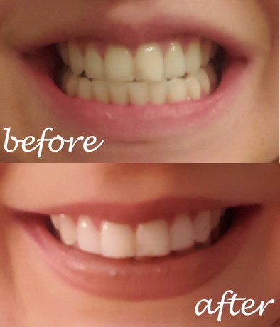 teethbeforeafter